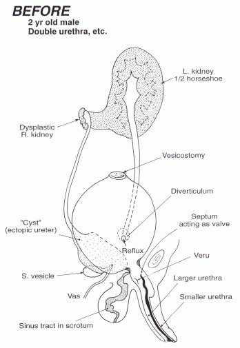 Urinary Tract Reconstruction Patient 3: Male Infant With Horseshoe 