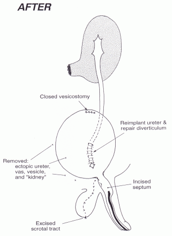 Urinary Tract Reconstruction Patient 3: Male Infant with Horseshoe ...