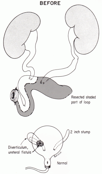 Urinary Tract Reconstruction Patient 5: Undiversion by Removing an ...